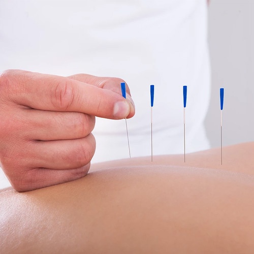 Acupuncture for pain management