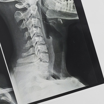 x-ray of neck